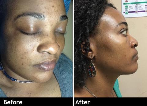 Glutathione Skin Lightening Capsules