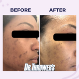 Acne & Dark Spot Removal Kit