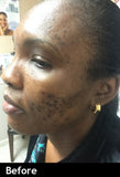 Hydrotret Cream | Blackhead/Whitehead Eraser