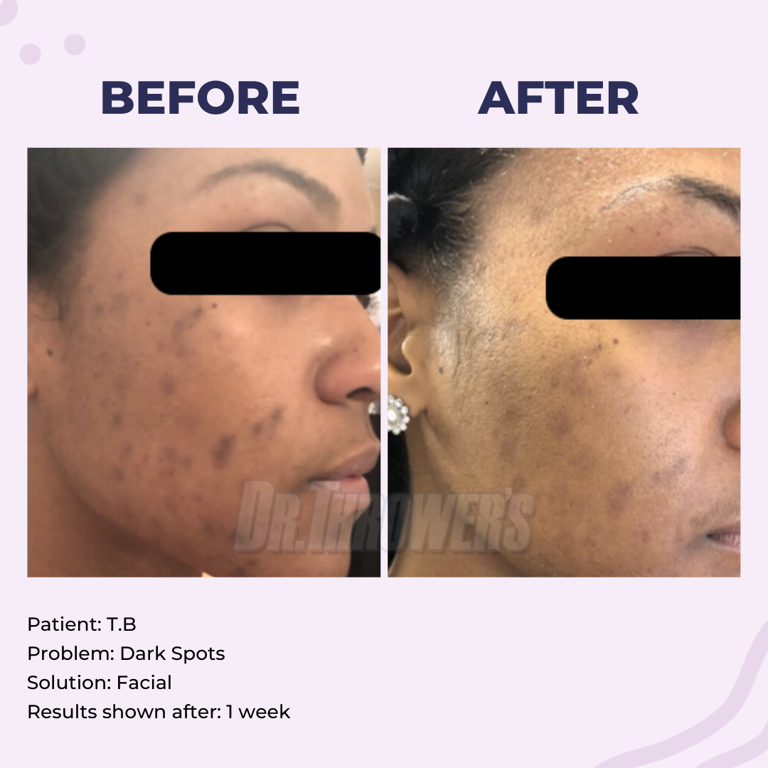 Dark spot removal online cream by dermatologist