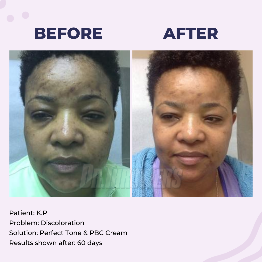 Skin discoloration cream deals