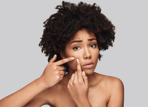 8 Unfounded Myths About Acne You Shouldn't Adopt