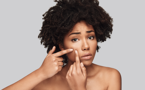 8 Unfounded Myths About Acne You Shouldn't Adopt