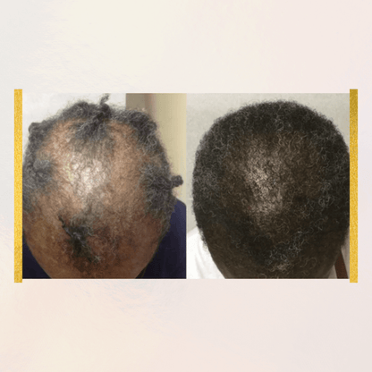 Thro-Grower Minoxidil 5% | Advanced Hair Regrowth