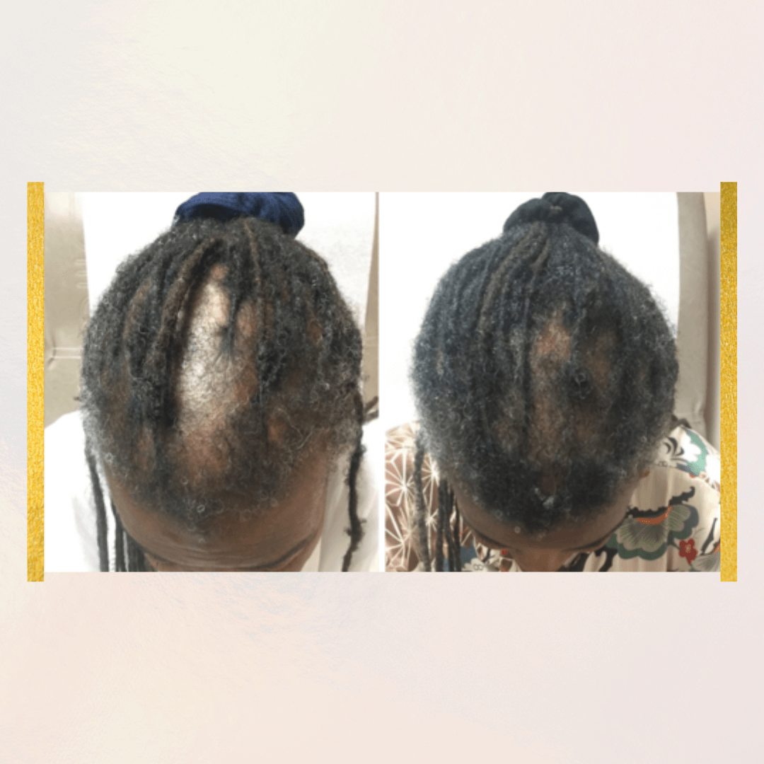 Thro-Grower Minoxidil 5% | Advanced Hair Regrowth