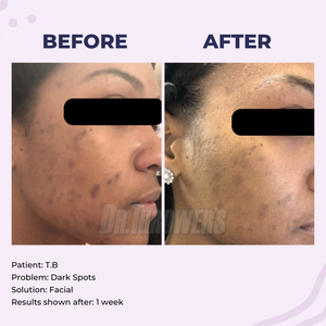 Dark Spot Fade | Medium Dark Spot Remover